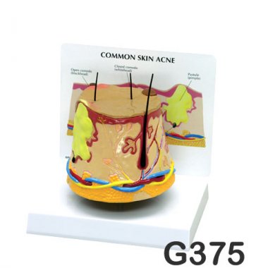 [GPI]여드름피부모형<br>G375
