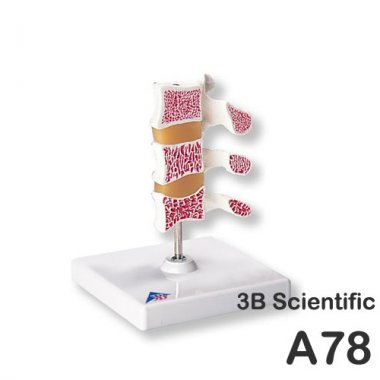 [3B]척추골다공증<br>A78